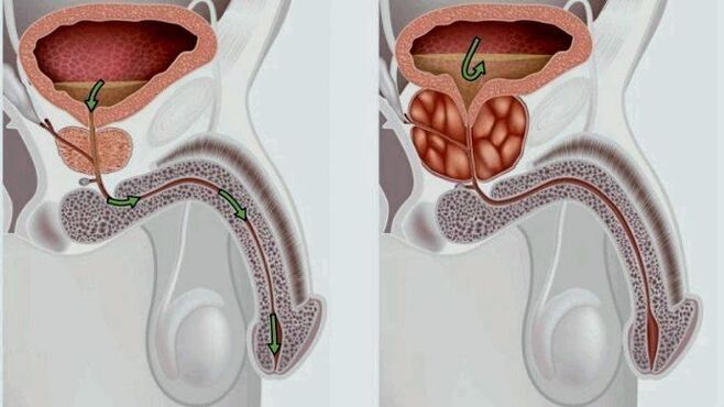 healthy and inflamed prostate with prostatitis