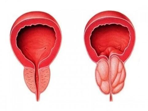 Healthy and inflamed prostate